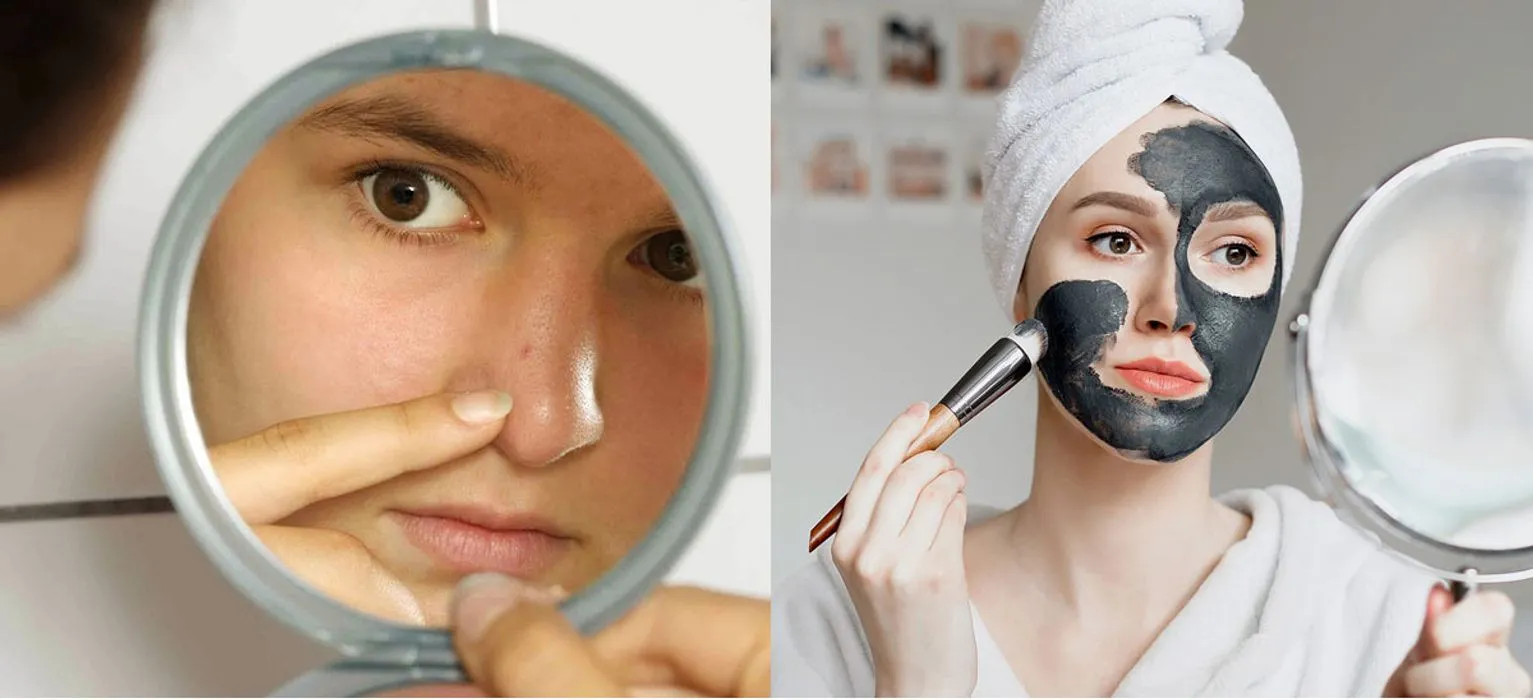 Mụn đầu đen và 6 thói quen sai lầm cần tránh khi chăm sóc da tại nhà